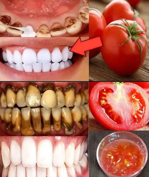 The strongest teeth whitening recipe at home in 2 minutes/Whitening yellow teeth from tartar naturally effective