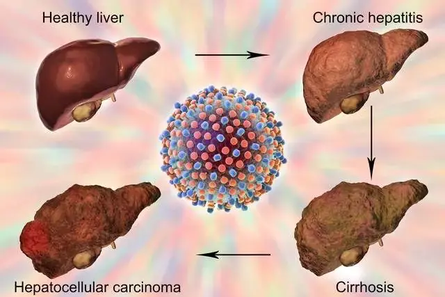 Is Hepatitis B a One-Way Ticket to Liver Cancer?  Hepatology Specialist: Follow These 3 Steps to Keep Hepatitis B Under Control