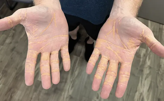 Man's Carnivore Diet Causes Strange Yellow Deposits on Skin Health