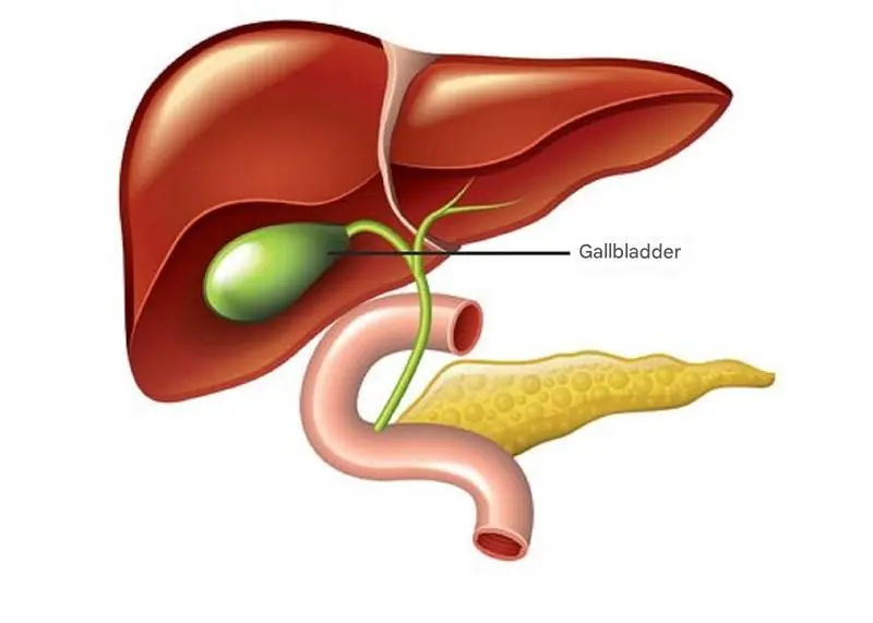 What Happens to the Body After Gallbladder Removal? 3 Diseases That May Follow – Avoid Surgery If Possible