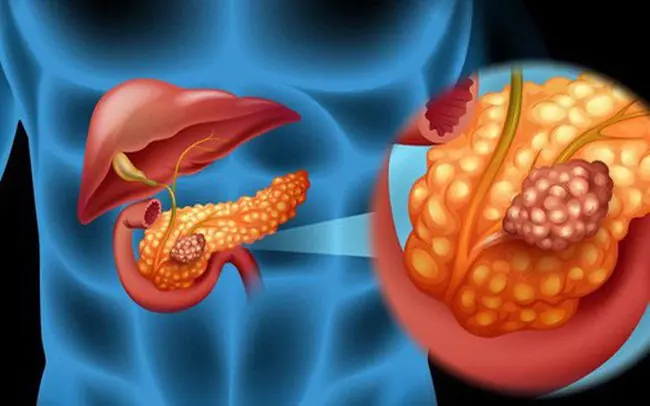 Doctor’s Warning: People Prone to Pancreatic Cancer Tend to Share These Common Traits – Here’s What You Need to Know