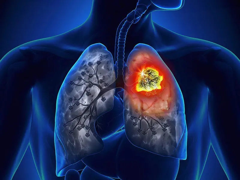 Is Lung Cancer Contagious? Can It Be Inherited? A Doctor Reveals the Truth