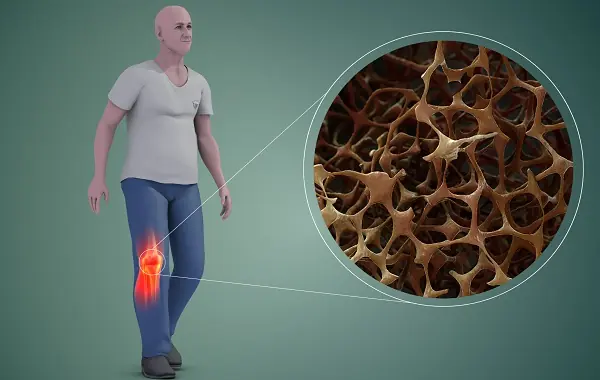 Osteoporosis Myths You Need to Stop Believing – Are You at Risk?