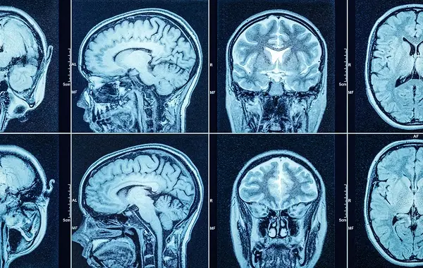 Why Some Doctors Advise Against Brain CT Scans? Essential Facts You Should Know