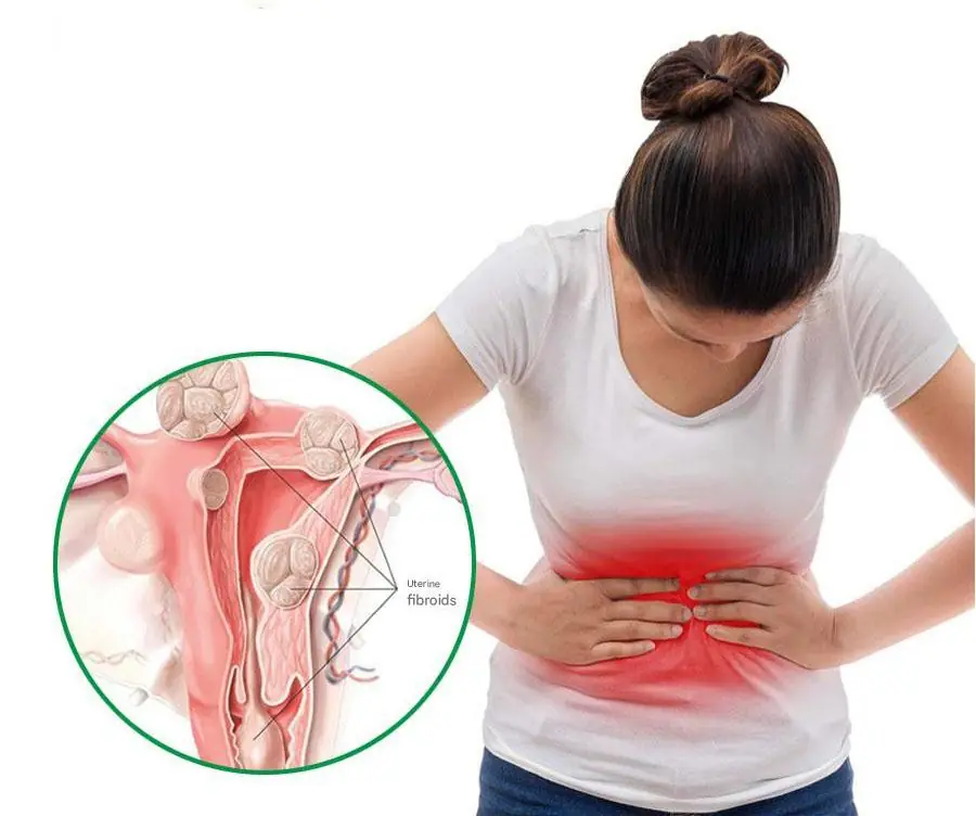 Uterine Fibroids: Four Key Symptoms Women Should Watch For