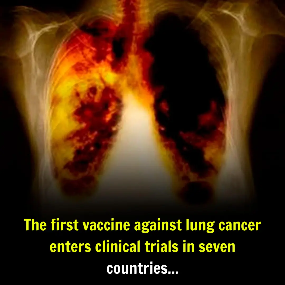 The First Lung Cancer Vaccine Enters Clinical Trial Phase in Seven Countries