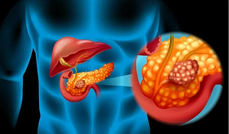 What Happens When Pancreatic Cancer Is Caused by Diet? Doctors Warn: People with a Weak Pancreas Should Avoid These Foods