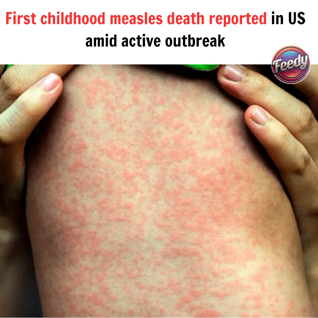 First childhood death from measles reported in the US amid active outbreak.