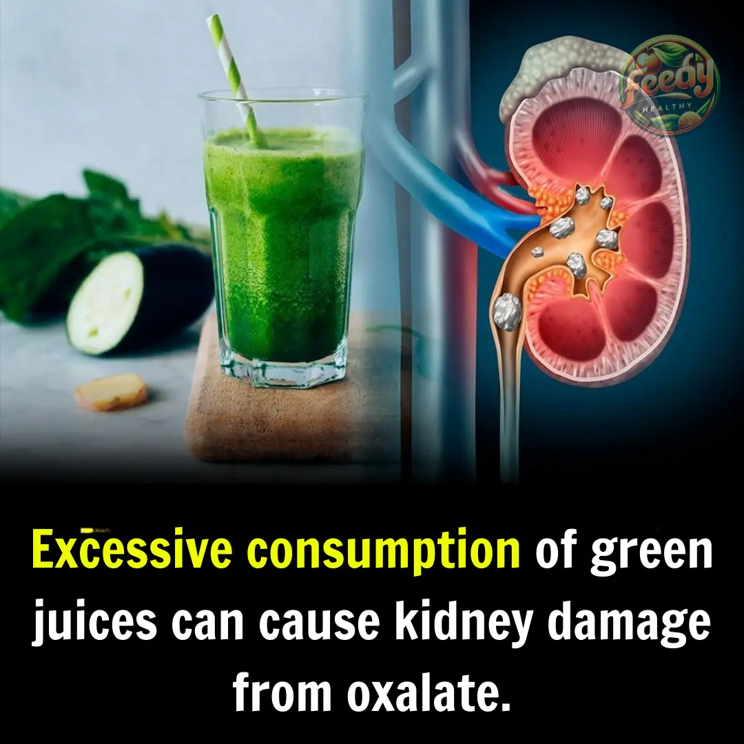 Excessive consumption of green juices can cause oxalate kidney injury.