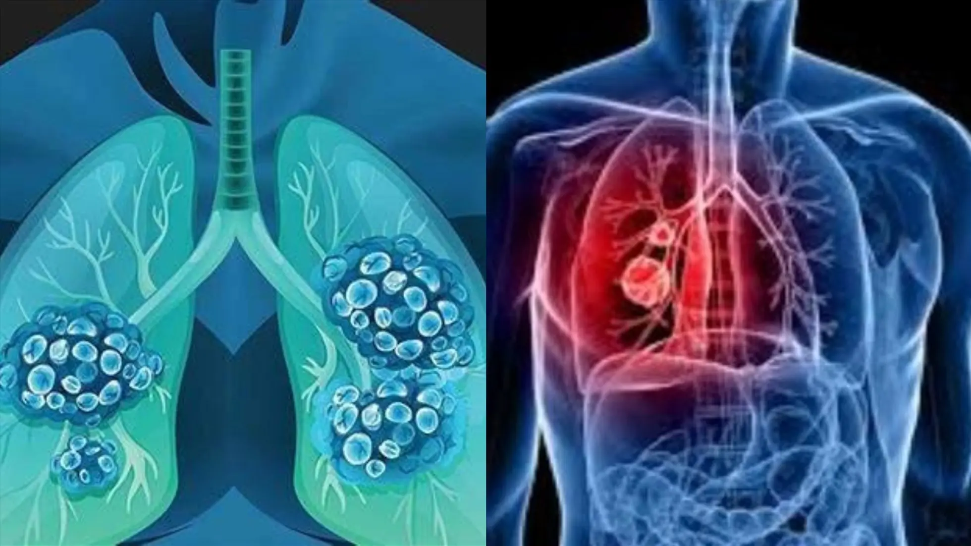 Is Lung Cancer Contagious? Is It Hereditary? Doctors Reveal the Truth!