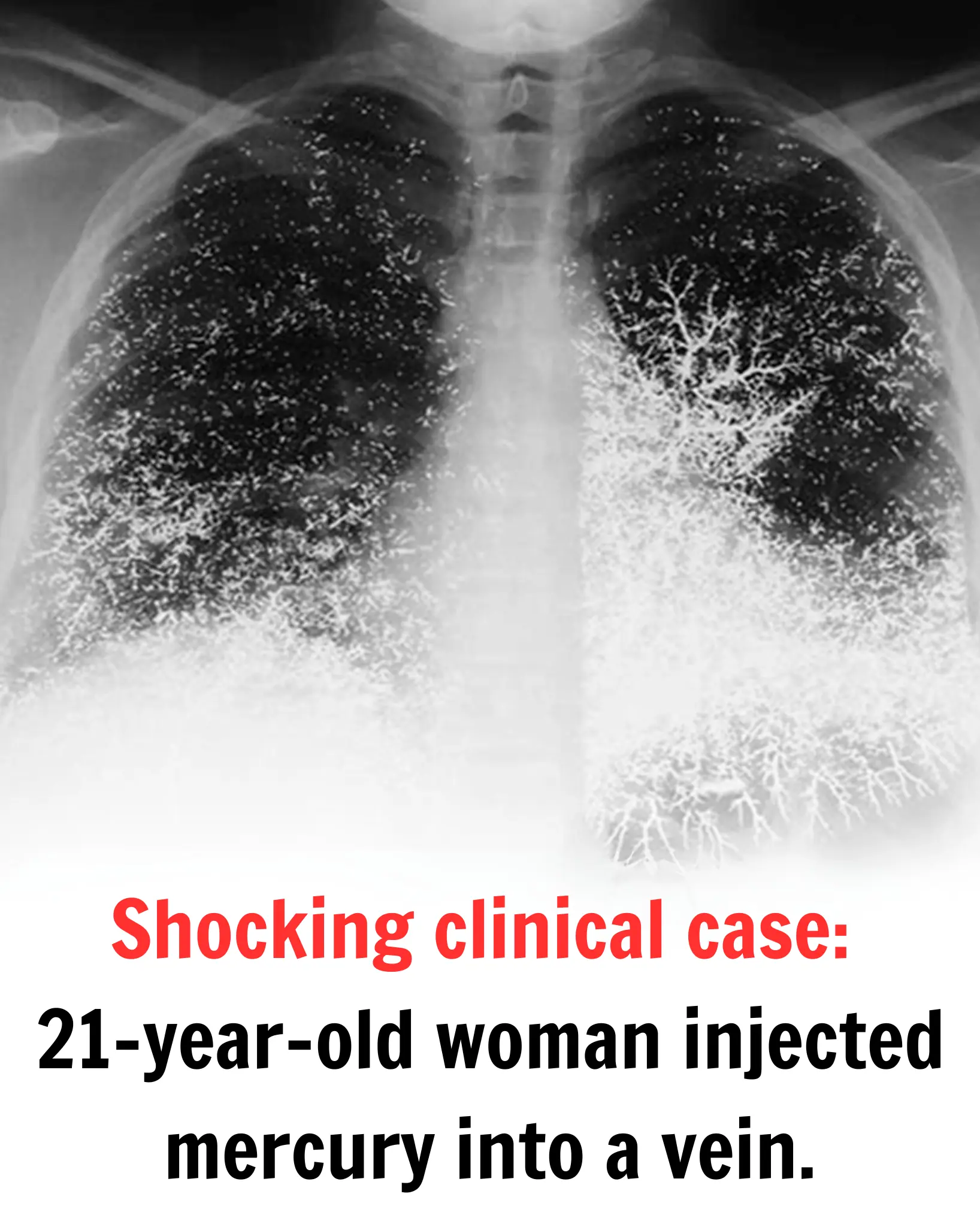 Shocking clinical case: a 21-year-old woman injected mercury into a vein.