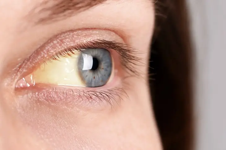 When the Liver Begins to Develop Cancer, the Eyes Often Give a "Signal" – Pay Attention!