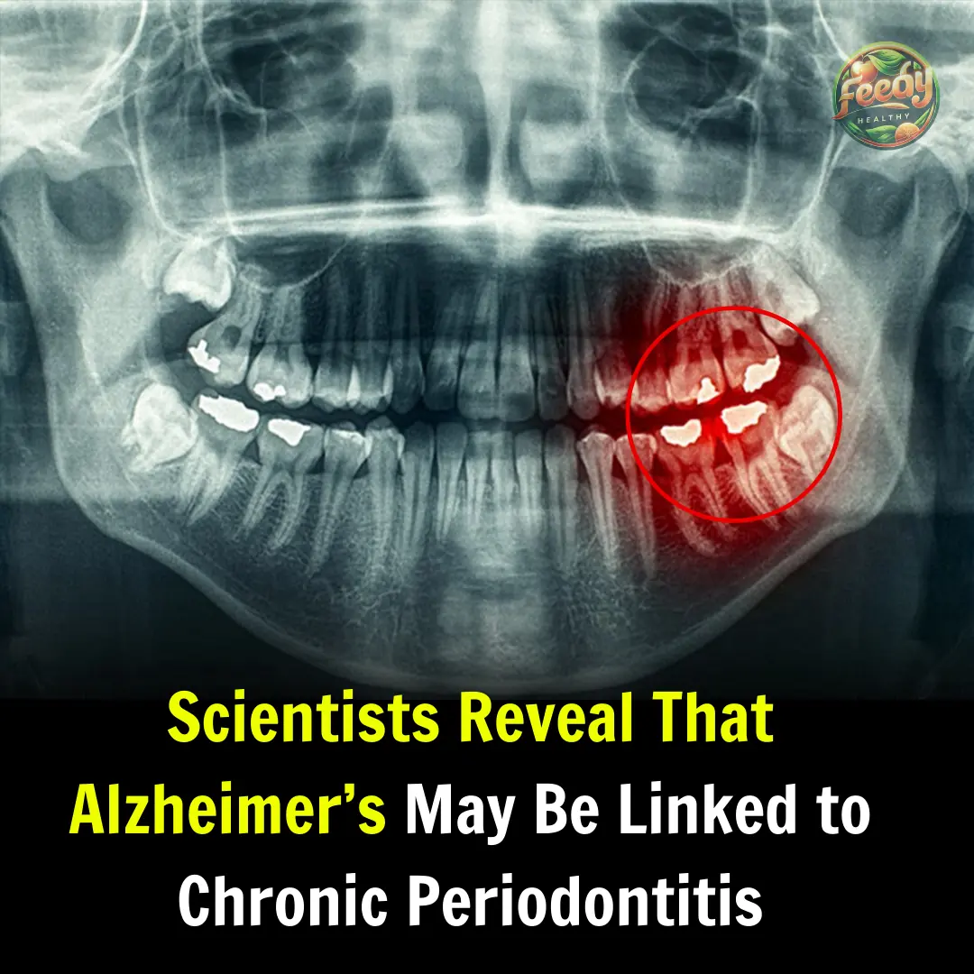 Scientists Reveal That Alzheimer’s May Be Linked to Chronic Periodontitis