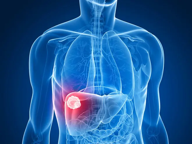 More and More People Are Dying from Liver Cancer!