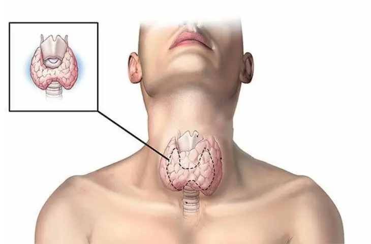 3 Breakfast Foods That Severely Damage the Thyroid