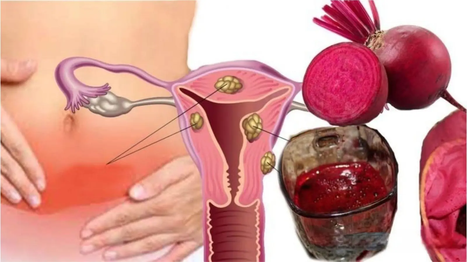 Beetroot: A Natural Remedy for Fibroids and Cysts