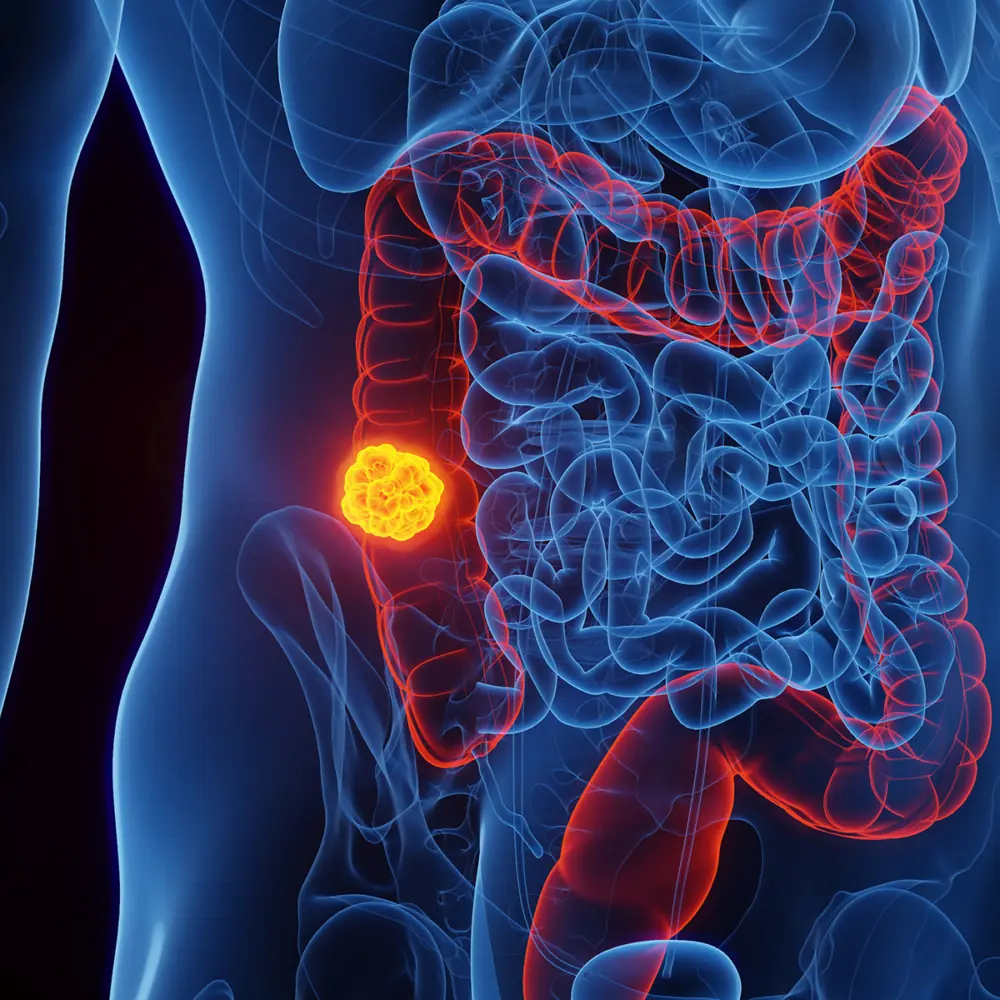 Woman reveals five colon cancer symptoms that should not be ignored