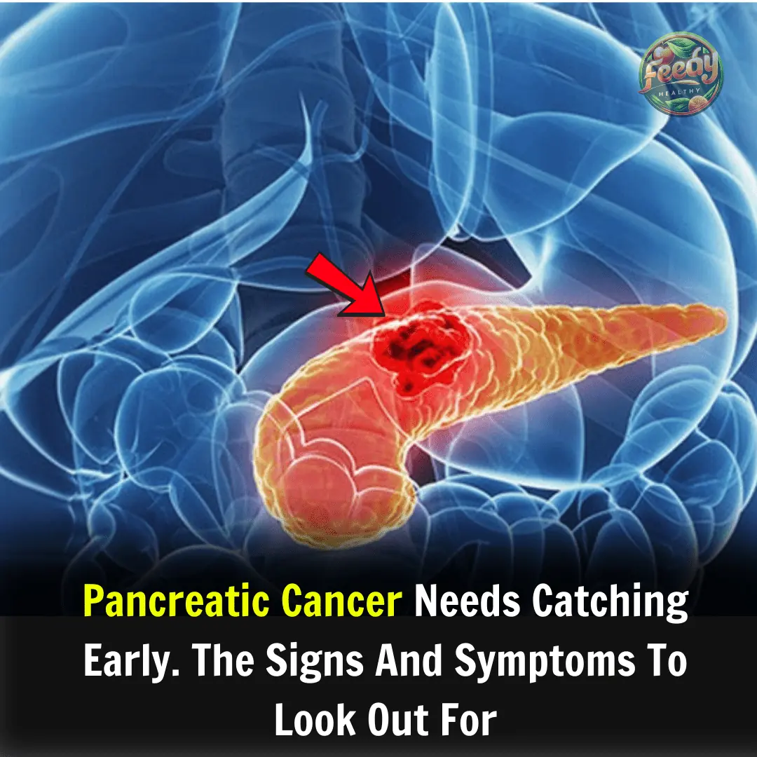 10 Signs of Pancreatic Cancer You Should Never Ignore