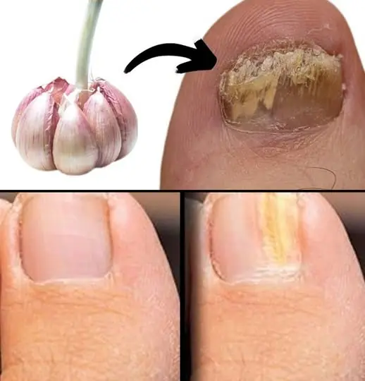 How GARLIC remove FUNGAL FOOT: Only polite members say thank you