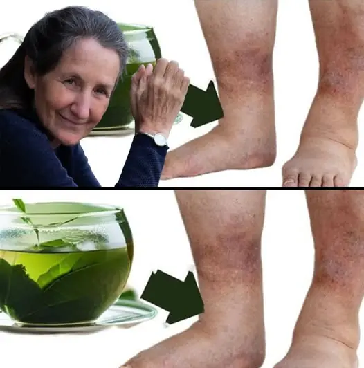 Discover the power of nature: TEA for impressively fast removal of swelling