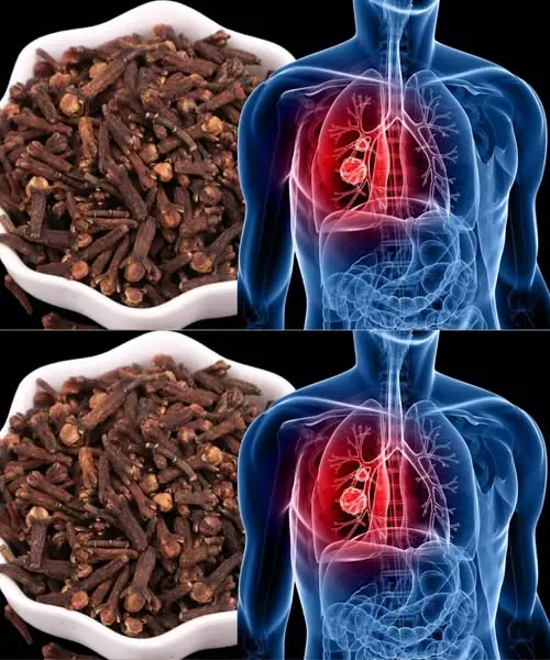 Breathe Easier Naturally: How Cloves Can Help Combat Respiratory Infections and Bronchitis