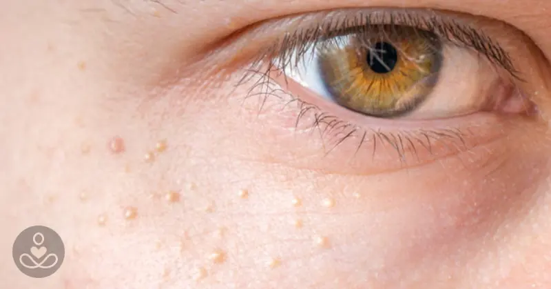 If You Have These Tiny, White Bumps on Your Face, Don’t Try to Remove Them!