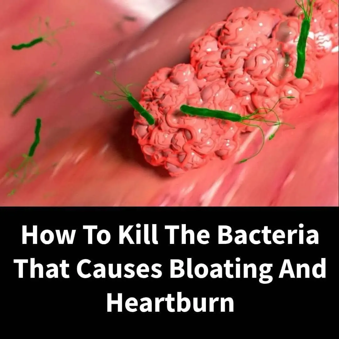 How to treat H. Pylori Bacteria Causing Heartburn And Bloating + Natural Remedies