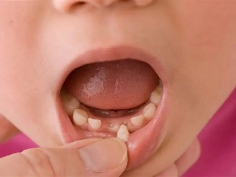 Attention, Parents! You Might Want To Hold On To Your Kids’ Baby Teeth