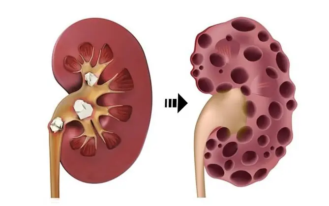 KIDNEY DISEASE SILENTLY CREEPS IN – IF YOU NOTICE THIS AT NIGHT, BEWARE!