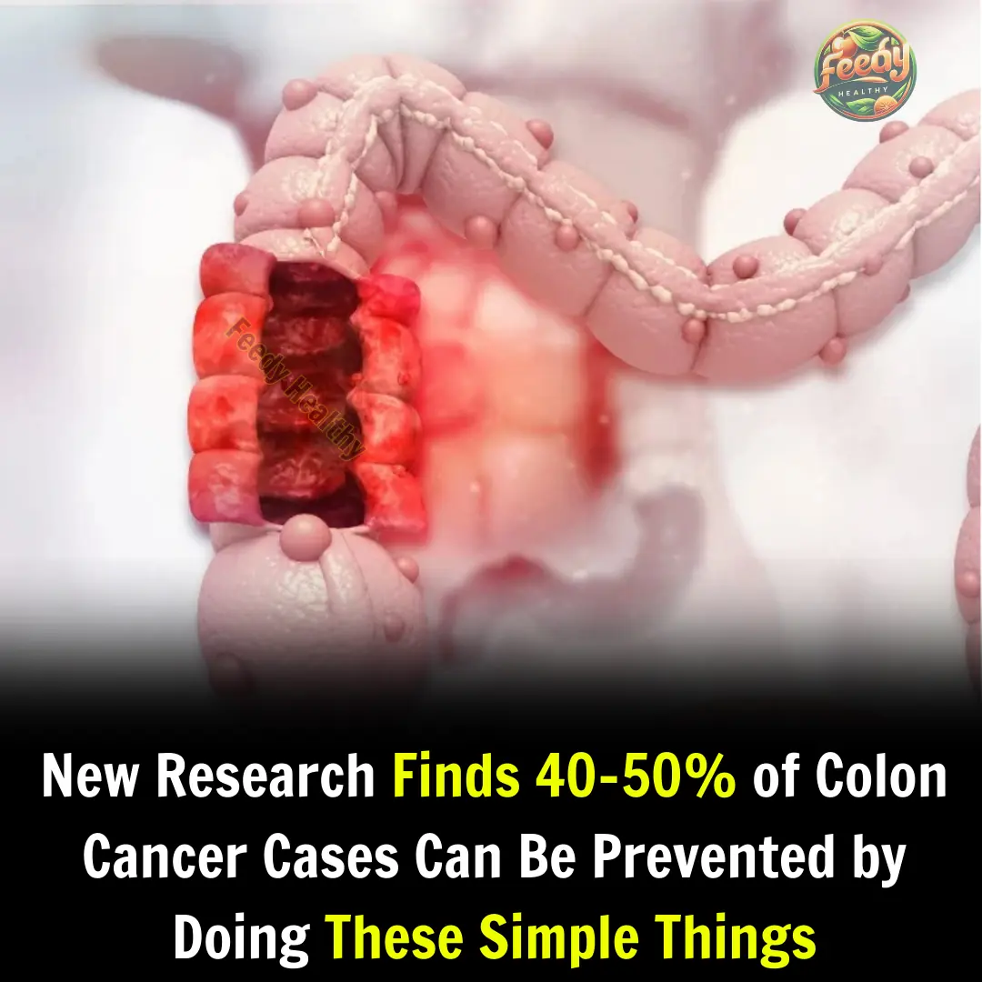 10 Ways to Help Reduce Your Colon Cancer Risk