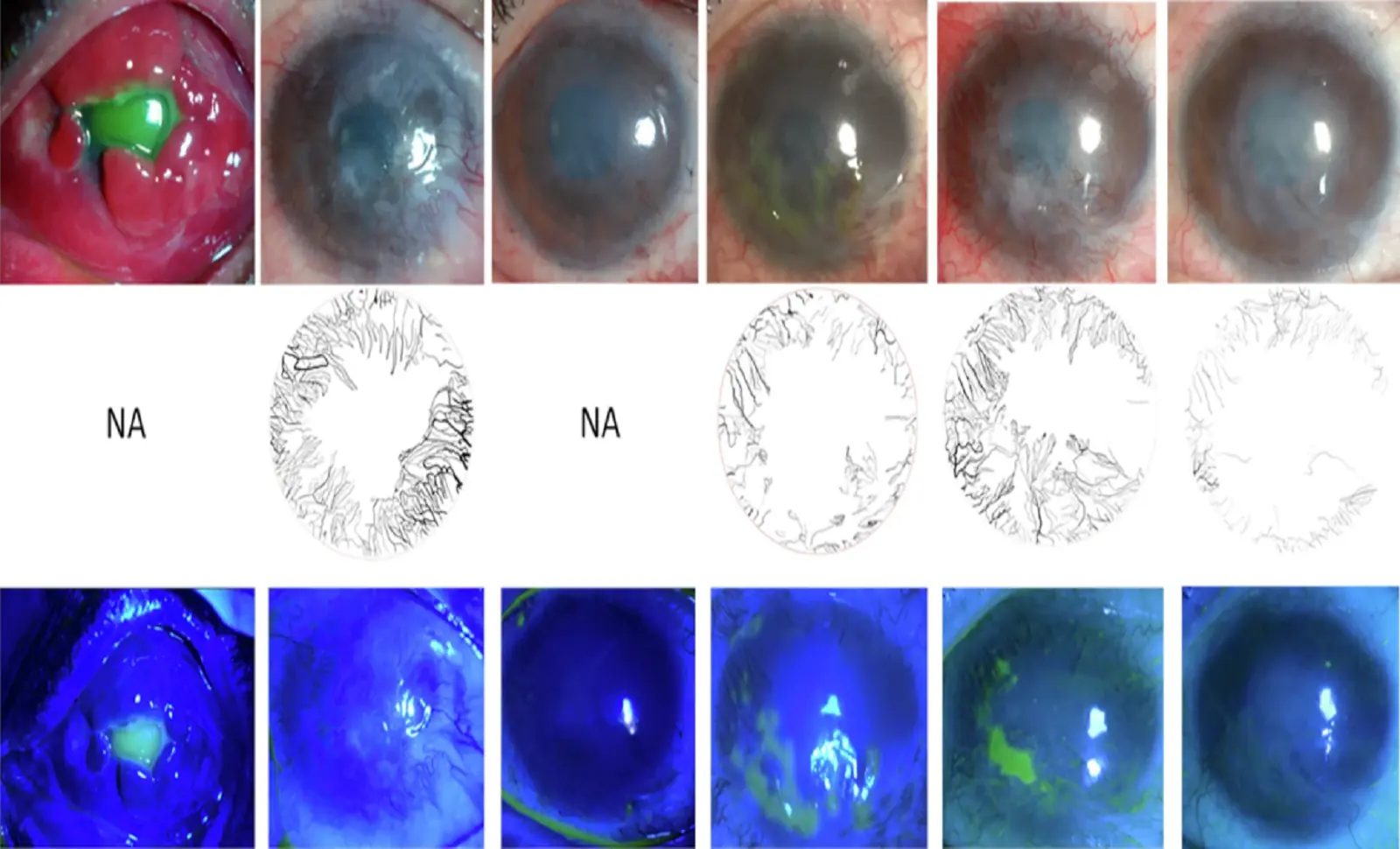 New Cellular Therapy Restores Damaged Cornea in 14 Blind Patients