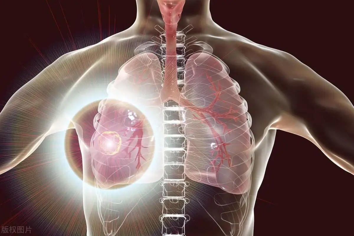 Is Lung Cancer Contagious or Hereditary? Doctors Reveal the Truth You Need to Know