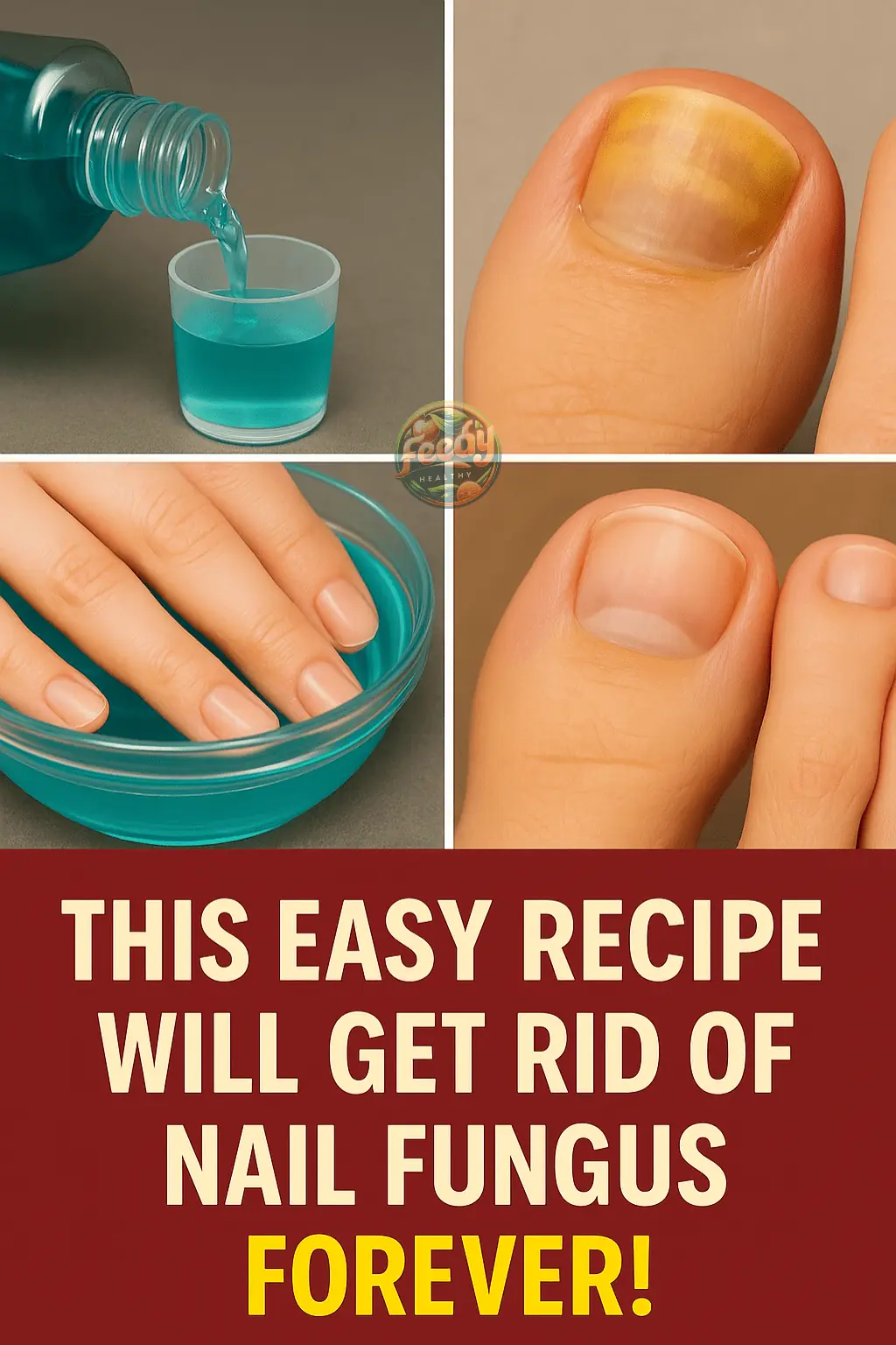 Say Goodbye to Nail Fungus with This Simple Home Remedy