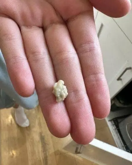 Hereโs what you need to know about tonsil stones โ the weird pimple-like growths in your throat