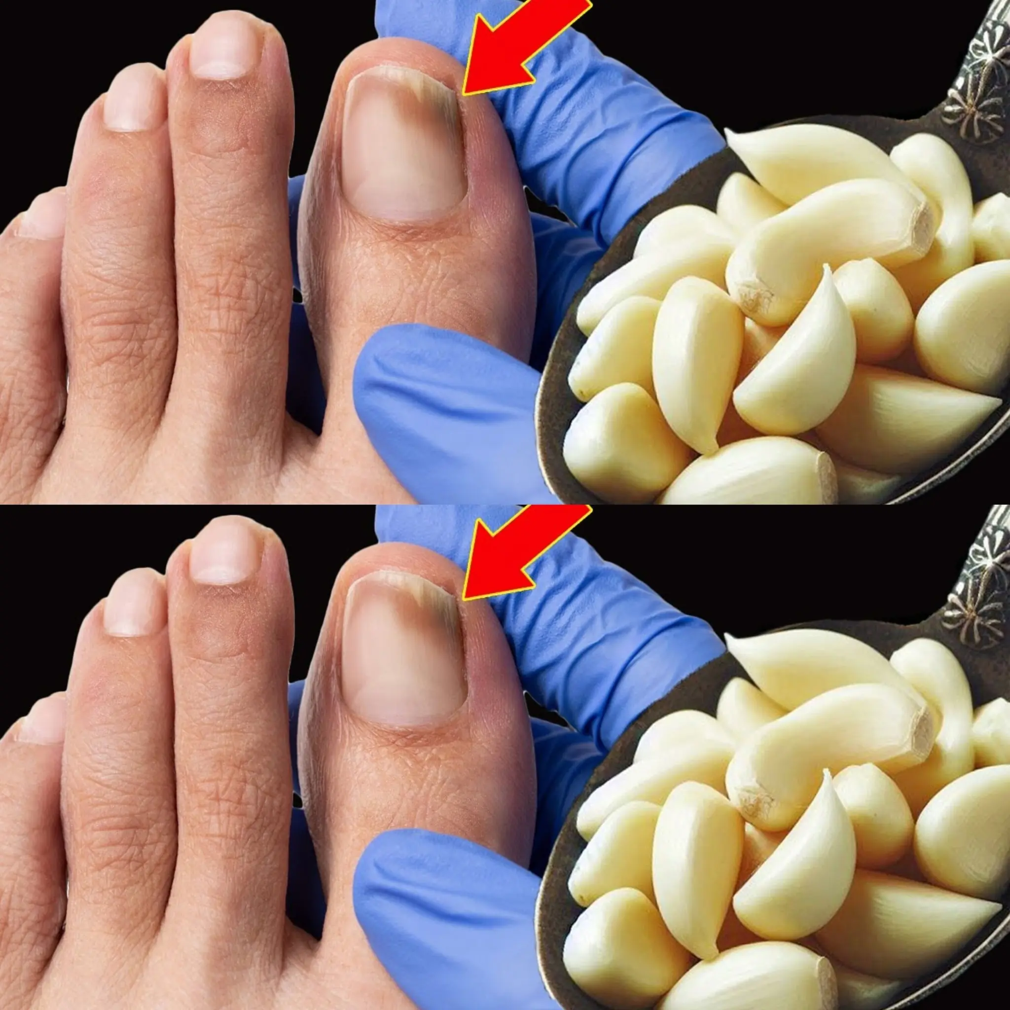 This is a Nail Fungus Killer! 🦠🔥 It Works Very Fast – The Power of Garlic!