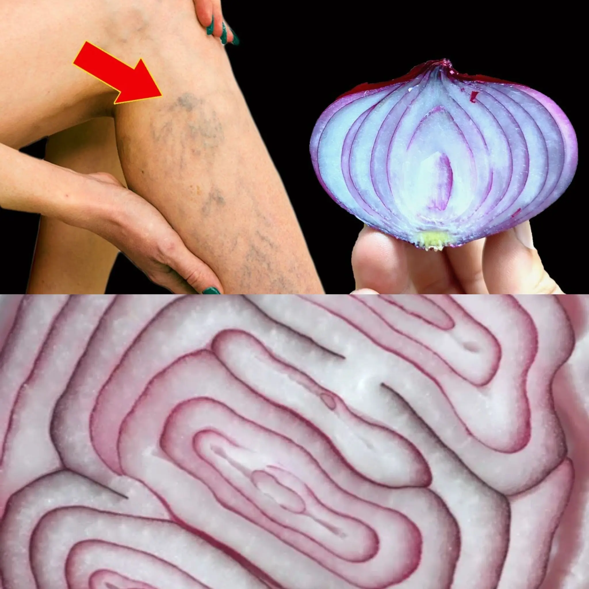 Unbelievable! 🤩 The Varicose Vein Killer – Red Onion Erases Varicose Veins Like an Eraser! 🚀✨
