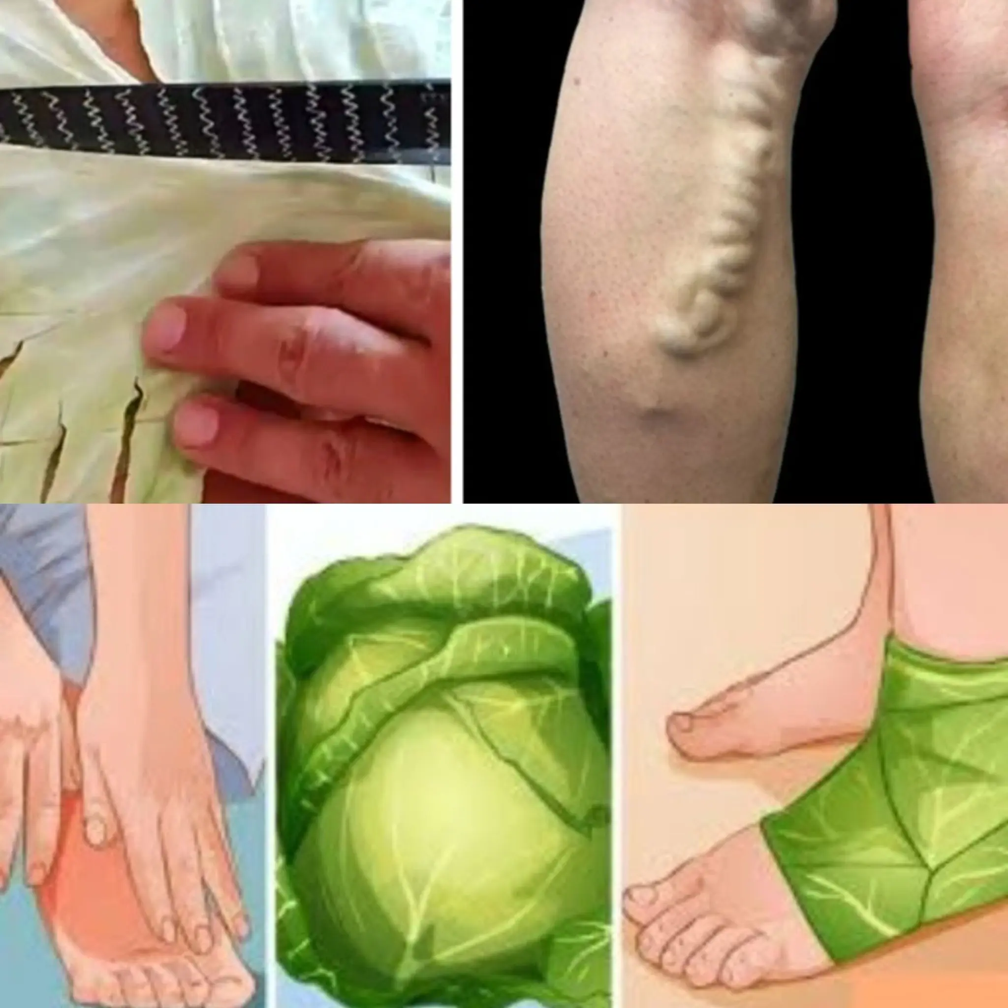 Amazing! Get Rid of Varicose Veins – Just Put These Leaves Over and Wait! 🌿