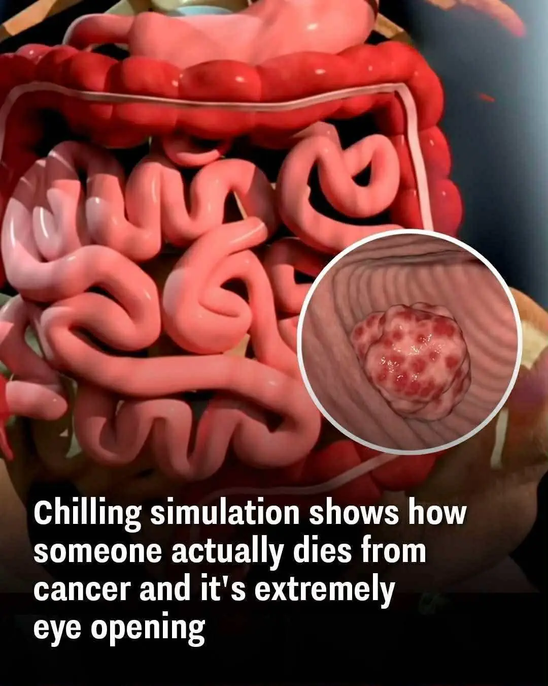 Striking simulation illustrates the progression of death from cancer