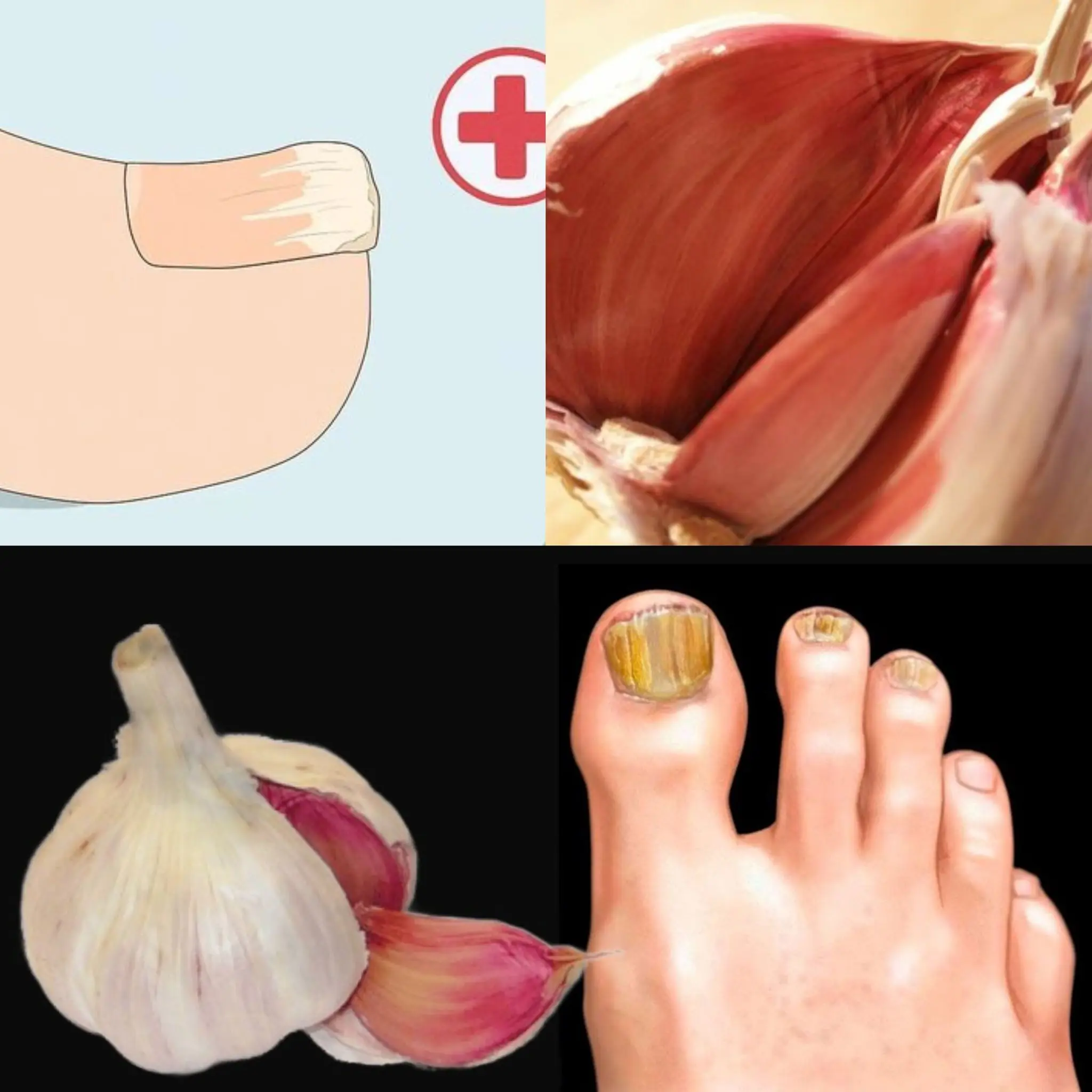Instantly Removes Nail Fungus Like an Eraser! ? Natural Remedy with Garlic ?