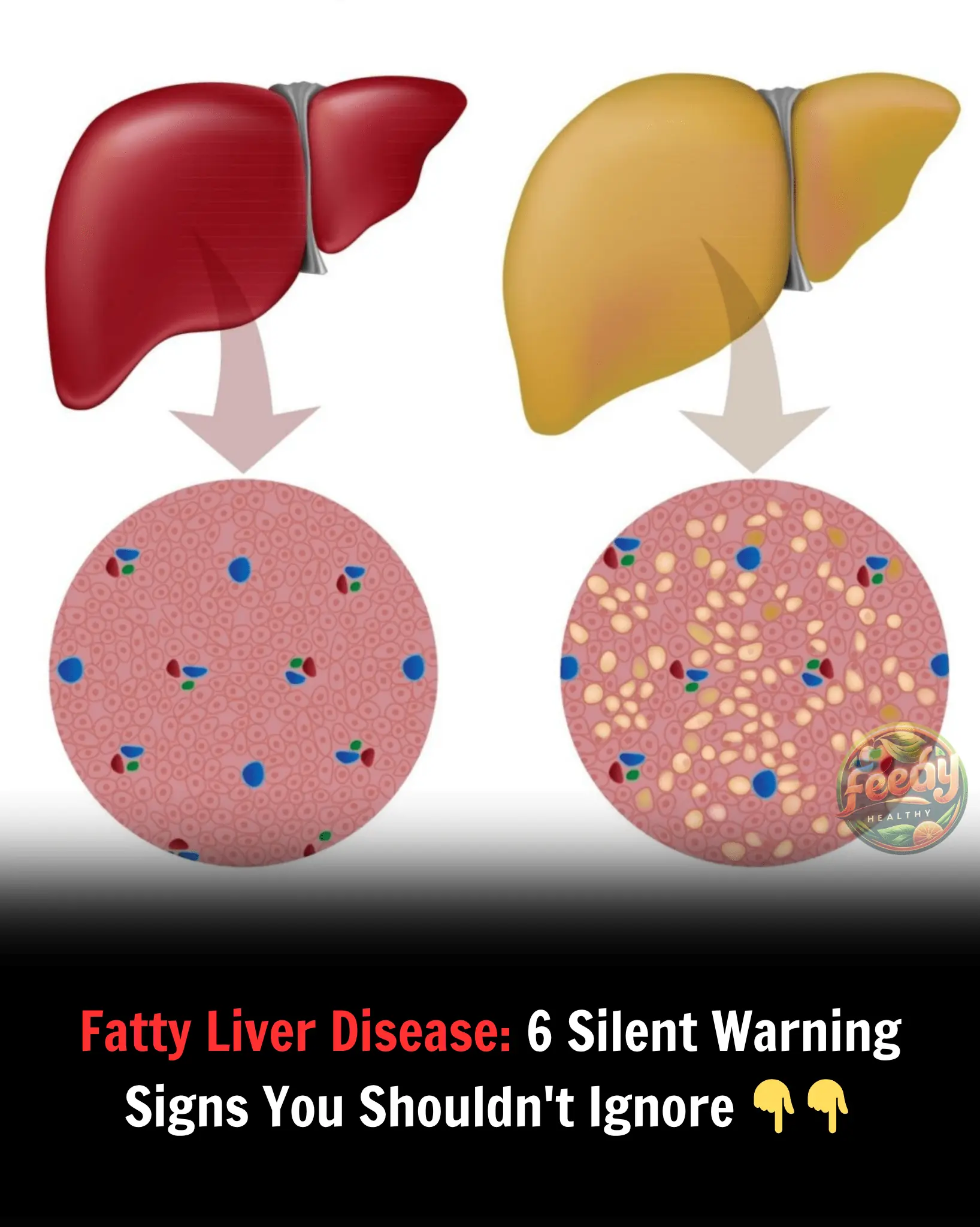 Fatty Liver Disease: 6 Silent Warning Signs You Shouldn't Ignore 👇👇