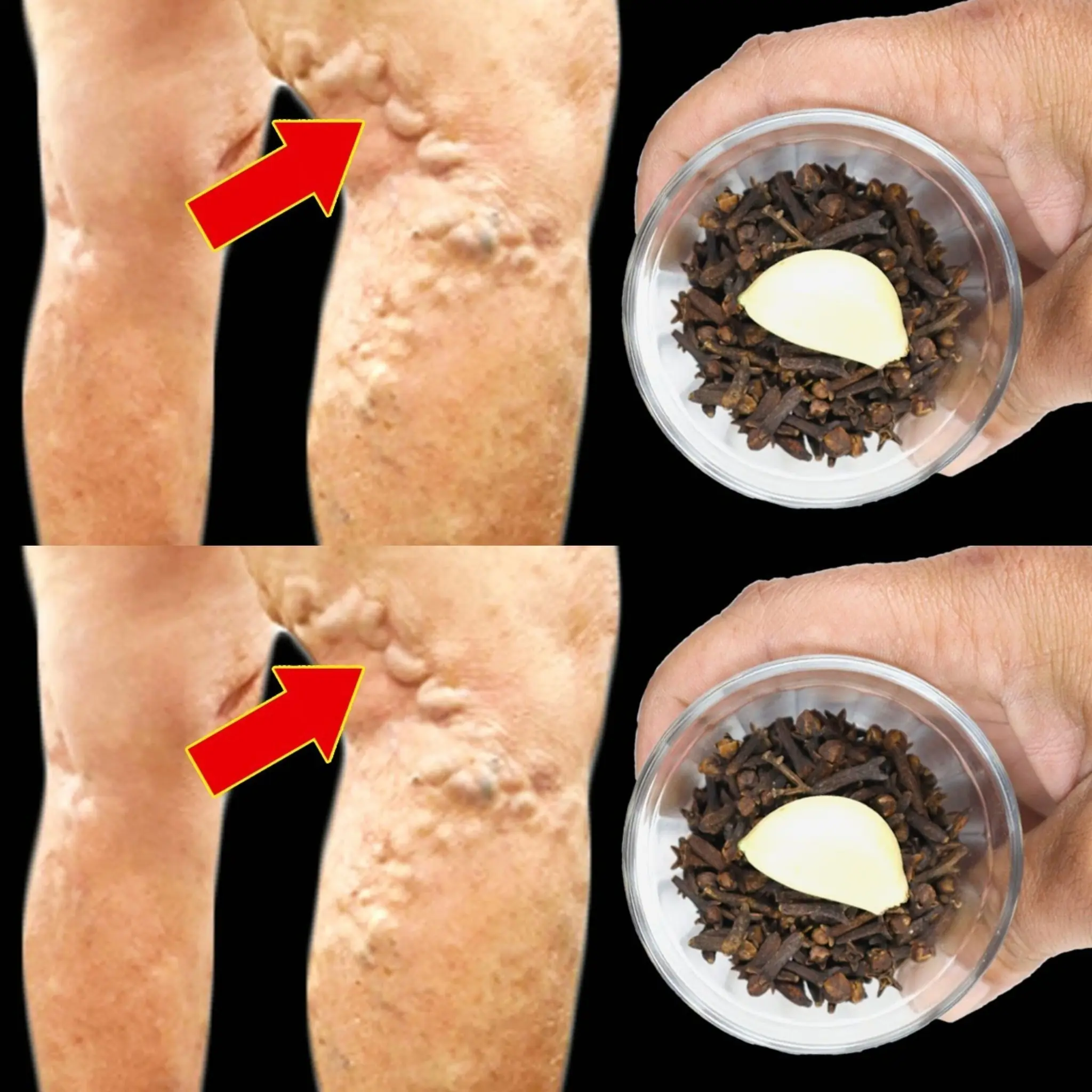 Unbelievable! 🤩 It’s a Varicose Vein Killer – Cloves and Garlic Erase Varicose Veins Like an Eraser! 🧄🌿