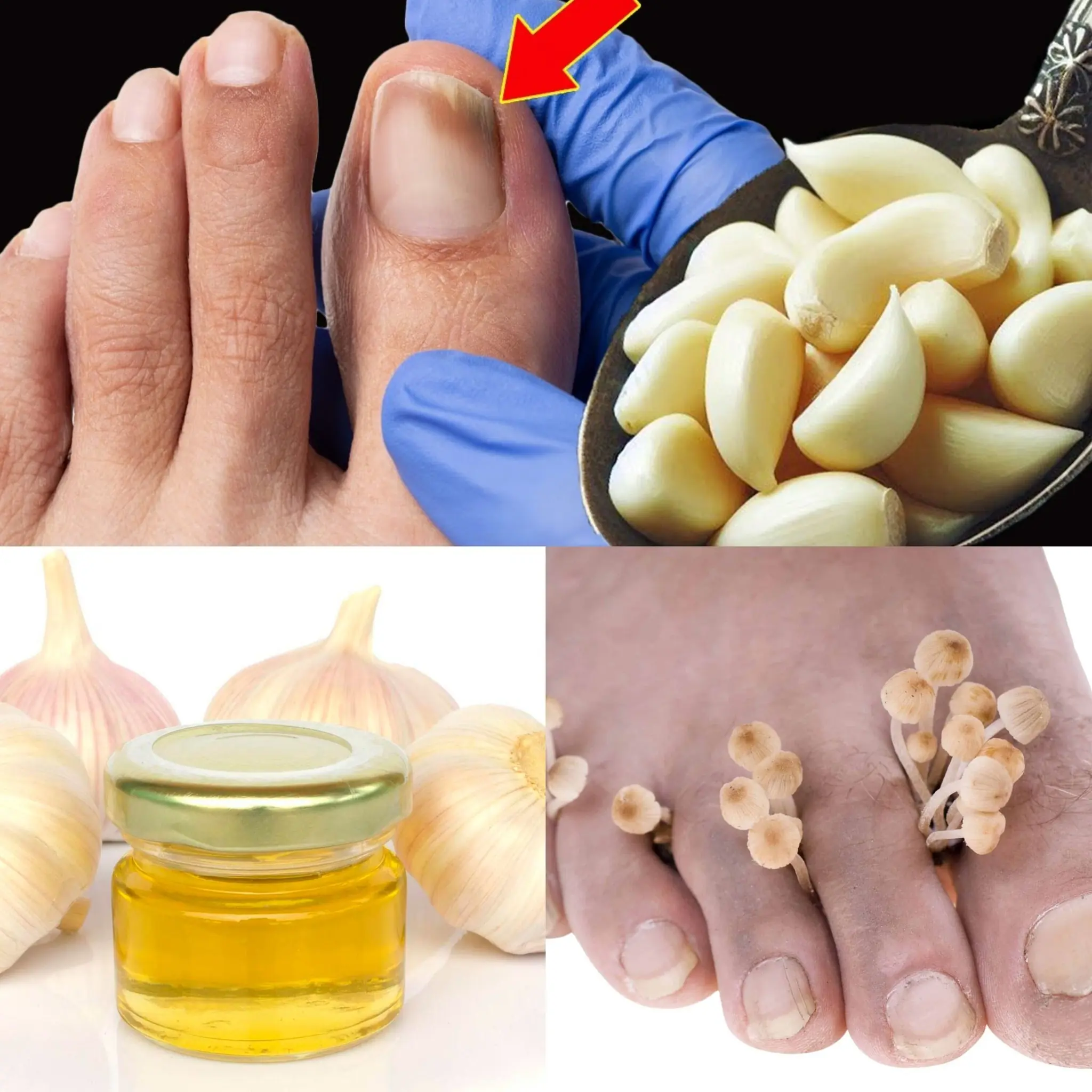 This Is a Nail Fungus Killer (It Works Very Fast!) – The Power of Garlic🧄