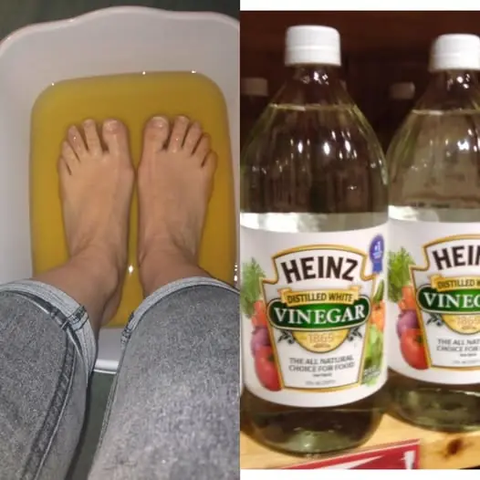 What Happens When You Put Vinegar on Your Feet?