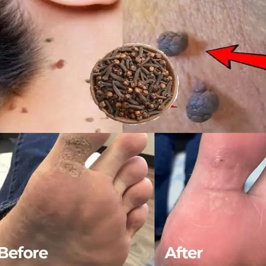 Cloves: The Natural Solution for Skin Tags and Warts