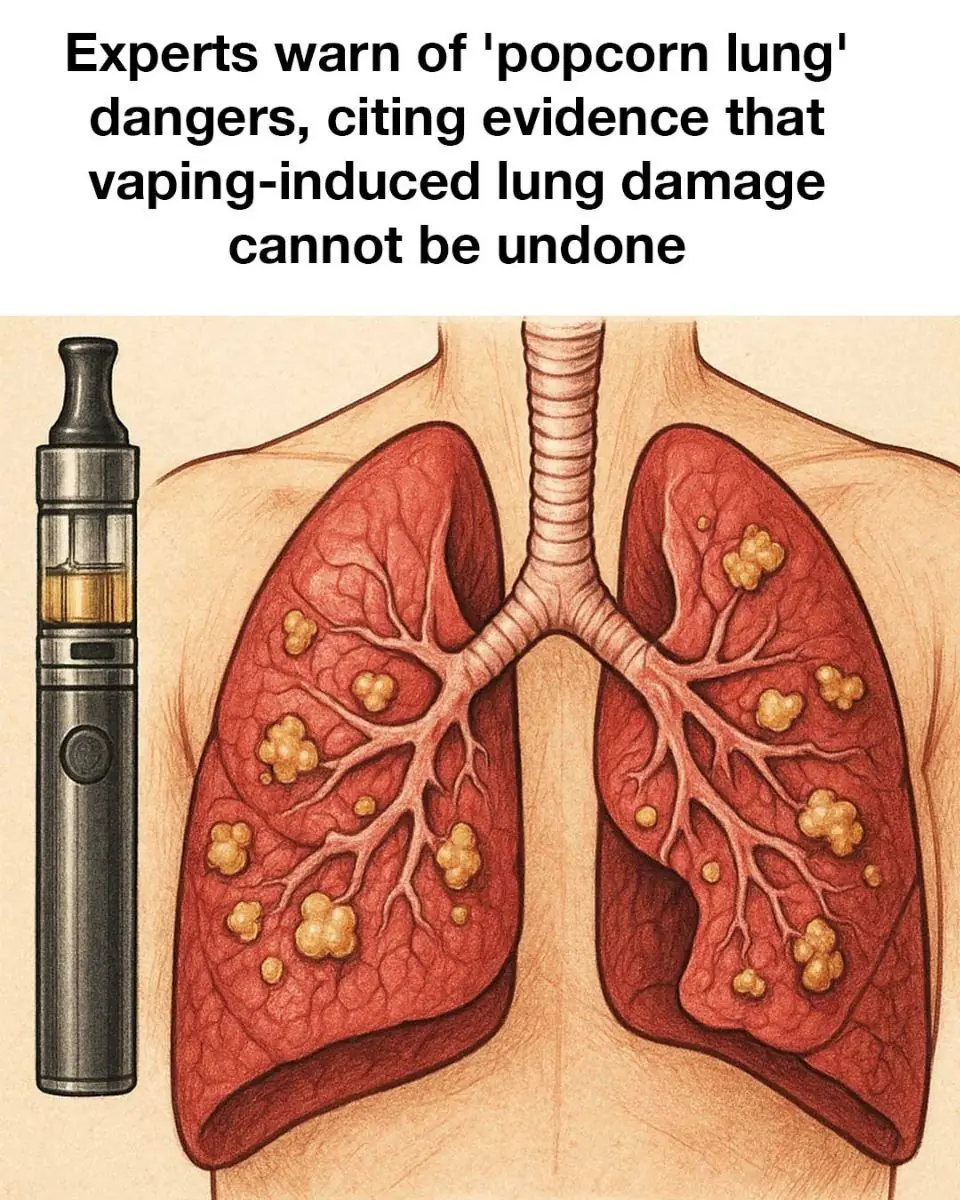 Experts warn of 'popcorn lung' dangers, citing evidence that vaping-induced lung damage cannot be undone