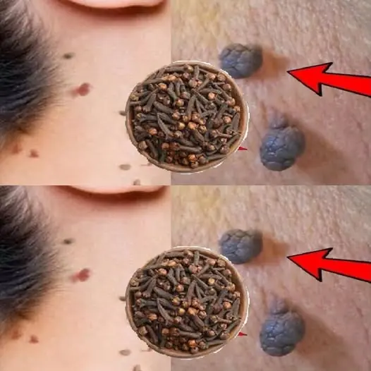 Cloves: A Natural Remedy for Skin Tags and Warts