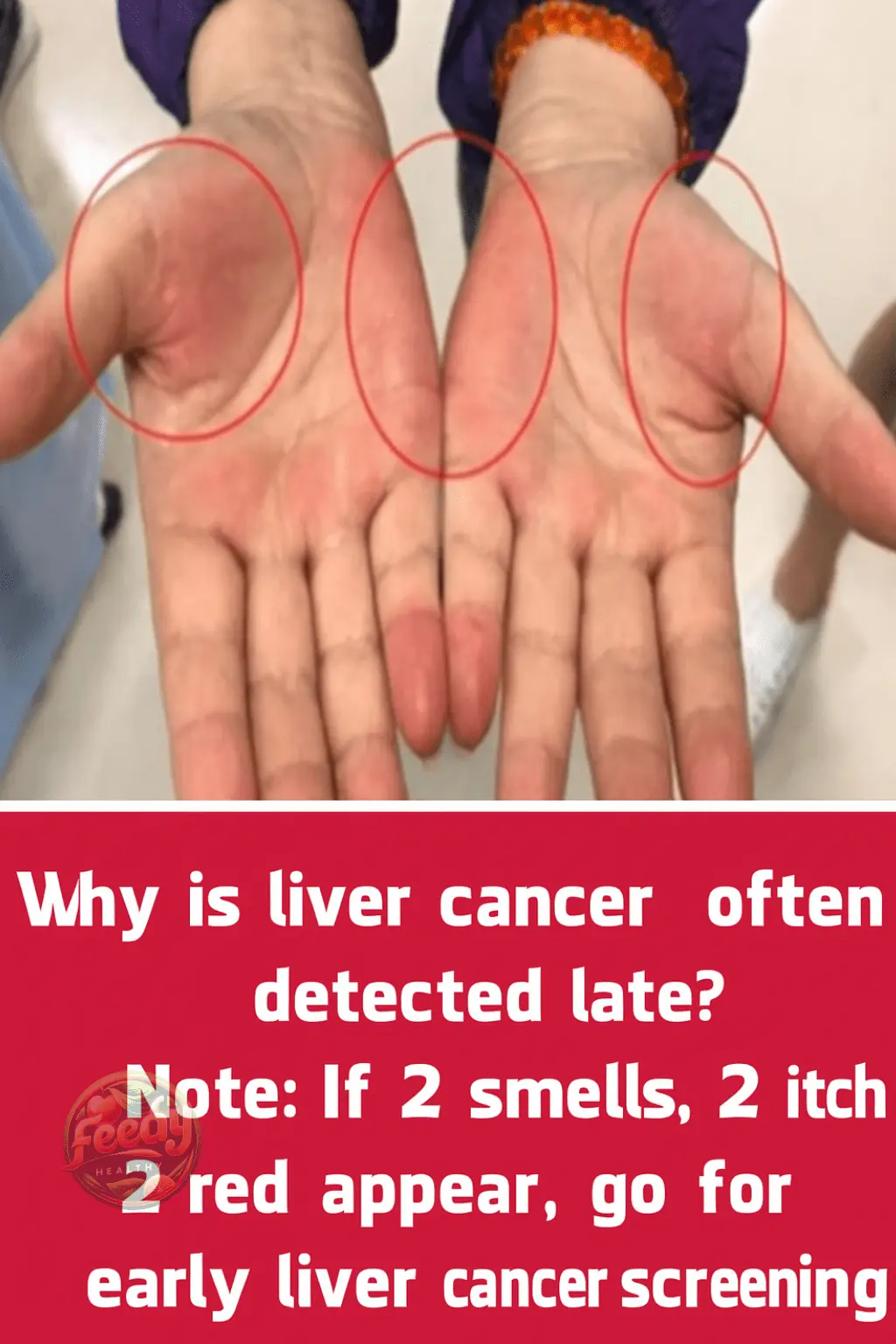 Why Is Liver Cancer Often Detected Late? Note: If You Notice 2 Odors, 2 Itches, and 2 Red Areas, Get Screened Early