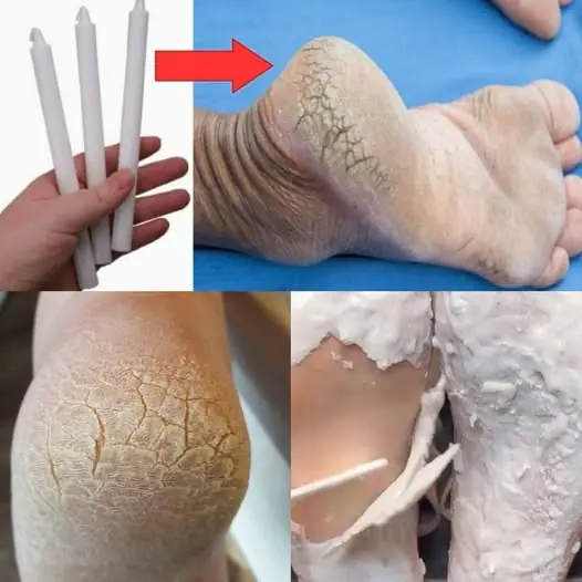 Say Goodbye to Dry, Cracked Heels with This Candle Wax Remedy!