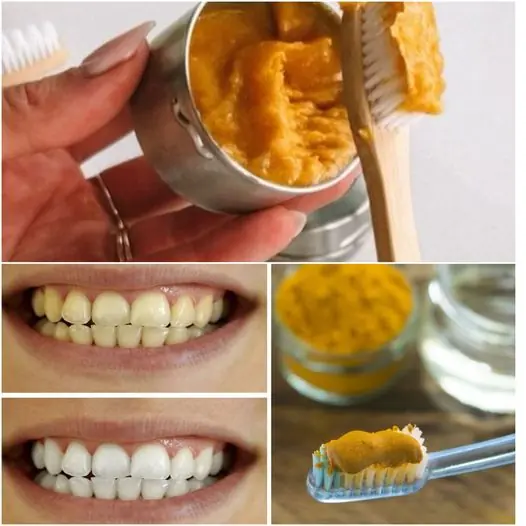Secret That Dentists Don’t Want You to Know: Remove Tartar and Whiten Teeth in Just 2 Minutes with Turmeric! 🦷✨