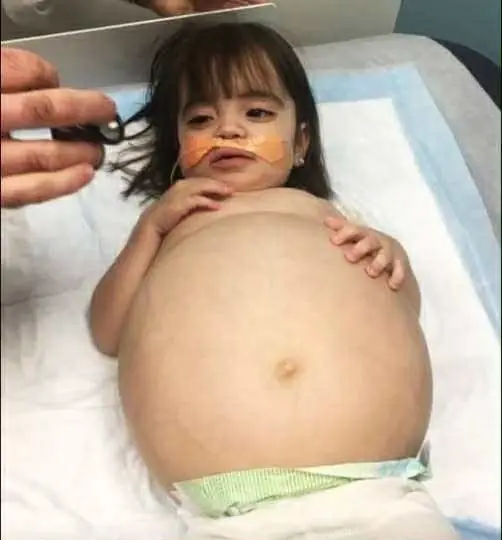 Little girl who looked 8 monthsβ pregnant because of deadly disease is saved thanks to dadβs kidney donation